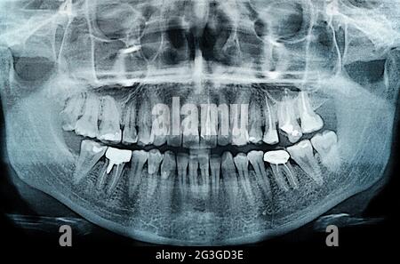 Radiography imaging upper and lower jaws teeth laboratory film Stock Photo
