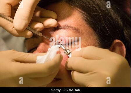 Healthcare concept - Chalazion during eye examination and operation Stock Photo