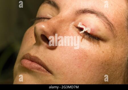 Healthcare concept - Medicine on eye - Chalazion during eye examination and operation Stock Photo