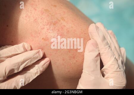 Doctor in rubber gloves examining skin of patient with red rash in clinic closeup Stock Photo