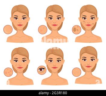 Seth woman different types of problem skin, enlarged area for cosmetology. Acne, wrinkles and age spots. Stock Vector