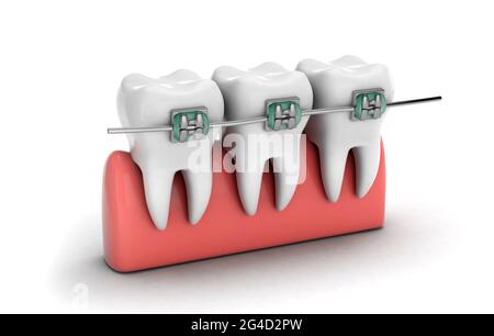 Teeth braces. Teeth alignment. Teeth in the gum isolated on a white background. 3d render. Stock Photo