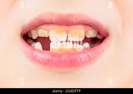 Bad teeth child. Portrait boy with bad teeth. Child smile and show her crowding tooth. Close up of unhealthy baby teeths. Kid patient open mouth Stock Photo