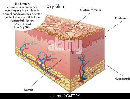 Medical illustration of the symptoms of dry skin Stock Vector Image ...