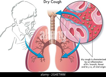 Medical illustration of the symptoms of dry cough. Stock Vector
