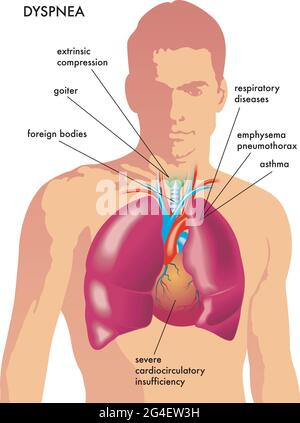 Medical illustration of the possible causes of dyspnea. Stock Vector