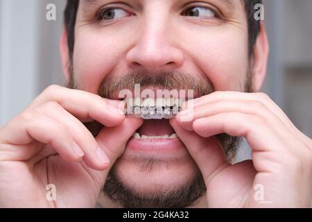Close up of young latin man putting orthodontic silicone trainer or invisible braces aligner. Mobile orthodontic appliance for dental correction. Stock Photo