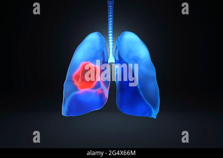 Digitally generated image of lungs with cancer Stock Photo