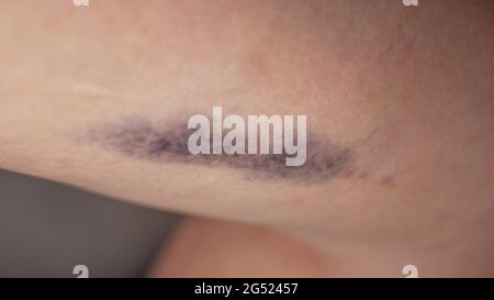Big bruising on a woman's thigh. Injury to the leg. Domestic violence. Stock Photo