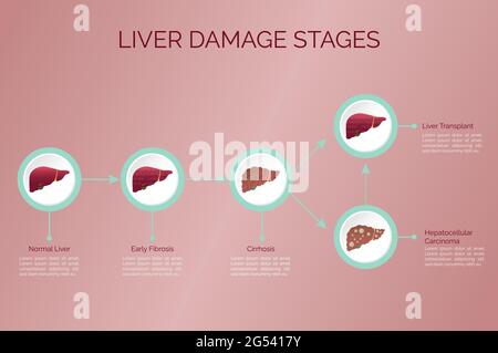 Infographic: stages of liver damage. Evolution of the liver up to transplantation. Stock Vector