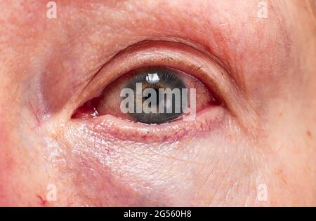 Eye of a woman with severe redness and hemorrhage in the eye coronovirus. Close-up Macro. Ophthalmic eye problems. An allergic reaction is irritation Stock Photo