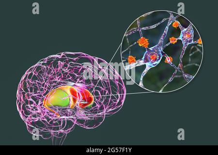 Dorsal striatum in Huntington's disease, illustration Stock Photo