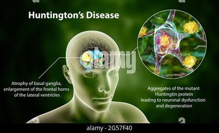 Dorsal striatum in Huntington's disease, illustration Stock Photo