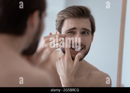 Frustrated handsome millennial guy concerned about facial skin problem Stock Photo