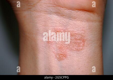 Red itchy patch rash on woman skin closeup Stock Photo - Alamy