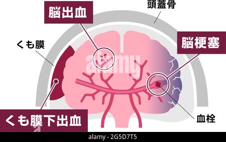 Types of human brain stroke vector illustration Stock Vector
