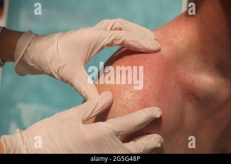 Doctor dermatologist examining rash on skin of man shoulders using gloves closeup Stock Photo