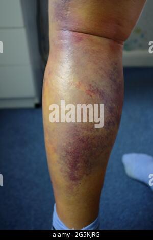 human male leg, showing the bruising (contusiona, haematoma) a week after being hit with a cricket ball (blunt trauma) Stock Photo