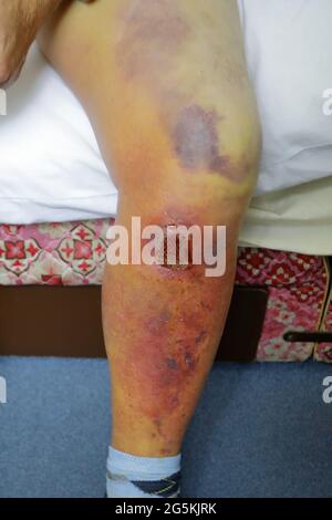 human male leg, showing the bruising (contusiona, haematoma) a week after being hit with a cricket ball (blunt trauma) Stock Photo