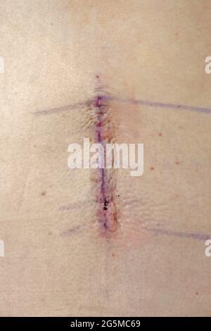 Along the spine, a four inch incision site is shown the day after a lumbar operation at a hospital. Stock Photo