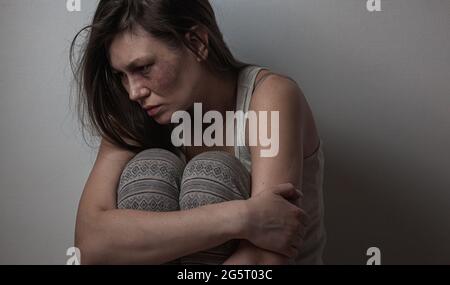 Domestic violence, abuse woman with bruise on face Stock Photo