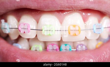 Premium Photo  Braces with blue and yellow rubber bands closeup