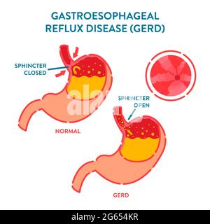 Gastroesophageal reflux disease, illustration Stock Photo