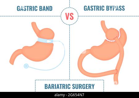 Gastric band vs gastric bypass, illustration Stock Photo