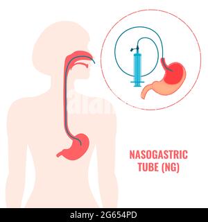 Nasogastric feeding tube, illustration Stock Photo