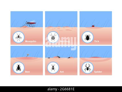Insect bites flat vector illustrations set. Mosquito drinking blood, tick getting under skin, bee sting. Bed bug, ant and spider bites. Skin lesion Stock Vector