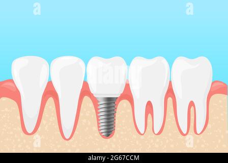 Vector illustration of human teeth and dental implant. Medicine dentists concept of teeth care in flat cartoon style. Stock Vector