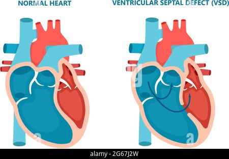 Ventricular septal defect VSD. Human heart muscle diseases cross-section. Cardiology concept. Stock Vector