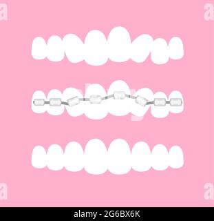 Vector illustration of the stages of orthodontic treatment braces on teeth . Teeth before and after braces on pink background in flat cartoon style. Stock Vector