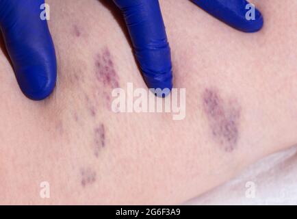 Bruises and thrombosis on the legs of a woman. Phlebeurysm, close-up Stock Photo