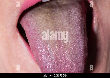 Close-up of a yellow coating on the girl's tongue. Sign of diseases of the gastrointestinal tract, liver and gallbladder disease, spleen Stock Photo