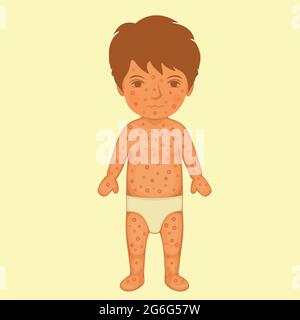 sick child, skin rash, chicken pox disease Stock Vector