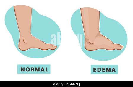 A swollen foot and ankle and a normal foot. Vector illustration of the disease Stock Vector