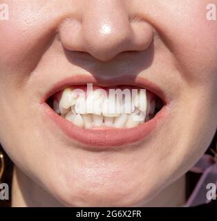 Curved female teeth, before installing braces. Close - up of teeth before treatment by an orthodontist Stock Photo