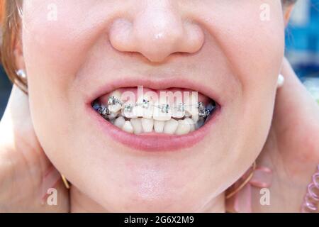 Curved female teeth, after installing braces. Close-up of the teeth after treatment at the orthodontist.Brasket system in a girl's smiling mouth, macr Stock Photo