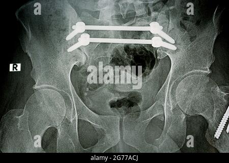 Plain x ray with a fracture pelvis that is fixed with 4 screws and 2 rods and fracture of greater trochanter of femur fixed with 2 screws Stock Photo