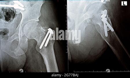 plain x ray on left hip joined with a fracture of the greater trochanter of femur fixed with 2 screws in an open reduction surgery Stock Photo
