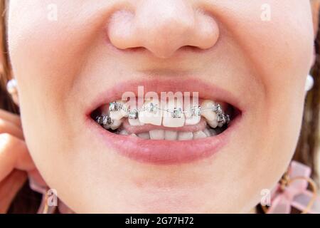 Curved female teeth, after installing braces. Close-up of the teeth after treatment at the orthodontist.Brasket system in a girl's smiling mouth, macr Stock Photo