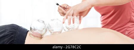 Man Getting Cupping Treatment At a Spa. Cupping Therapy. Treatment used in Traditional Chinese Medicine for pain relief and other health benefits. Stock Photo
