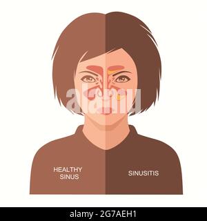 sinusitis disease, vector nose illustration, sinus anatomy, human ...