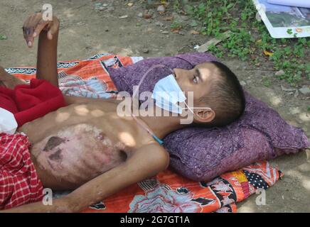 July 14,2021. Dhaka,Bangladesh: Saiful Islam, age 14 years. He was admitted to the burn unit of Dhaka Medical Hospital for three months and twenty day Stock Photo