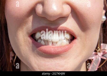 Curved female teeth, before installing braces. Close - up of teeth before treatment by an orthodontist Stock Photo