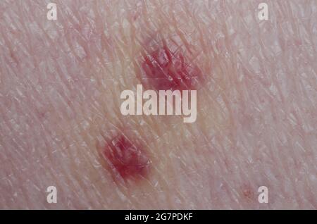 Rash on human skin due to chiggers, Family Trombiculidae Stock Photo ...