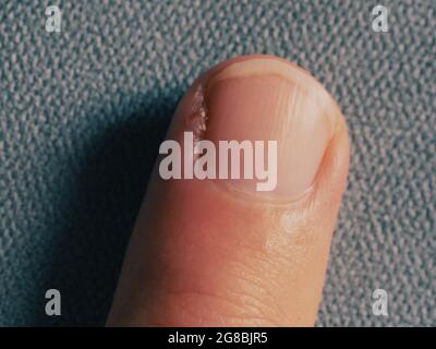 Inflamed cuticle on the finger. Damaged part of the finger, close-up. Stock Photo