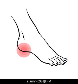 Leg with heel pain. Orthopedic disease plantar fasciitis. Beauty and health of feet. Vector isolated outline illustration Stock Vector