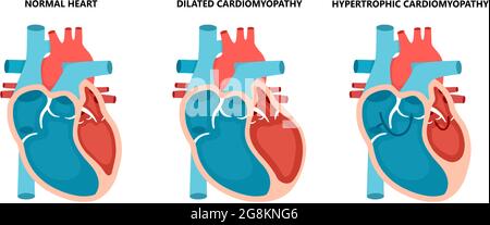 Types of heart diseases: hypertrophic cardiomyopathy and dilated ...